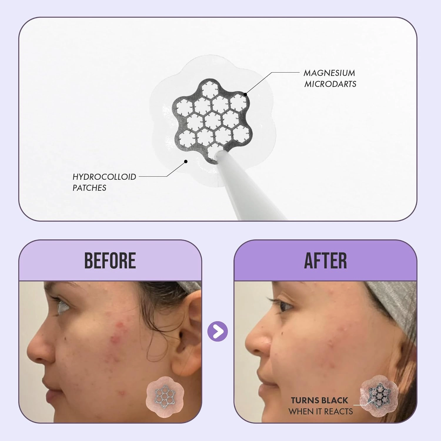 Deep Blemish Microdarts | Pimple Patch | Fast-Acting | Quick Calming | 99.9% Pure Magnesium | Madecassic Acid | Tea Tree | Eucalyptus Leaf | Hydrocolloid Spot Care Patch (7. SMALL 2PKS 20 PCS)