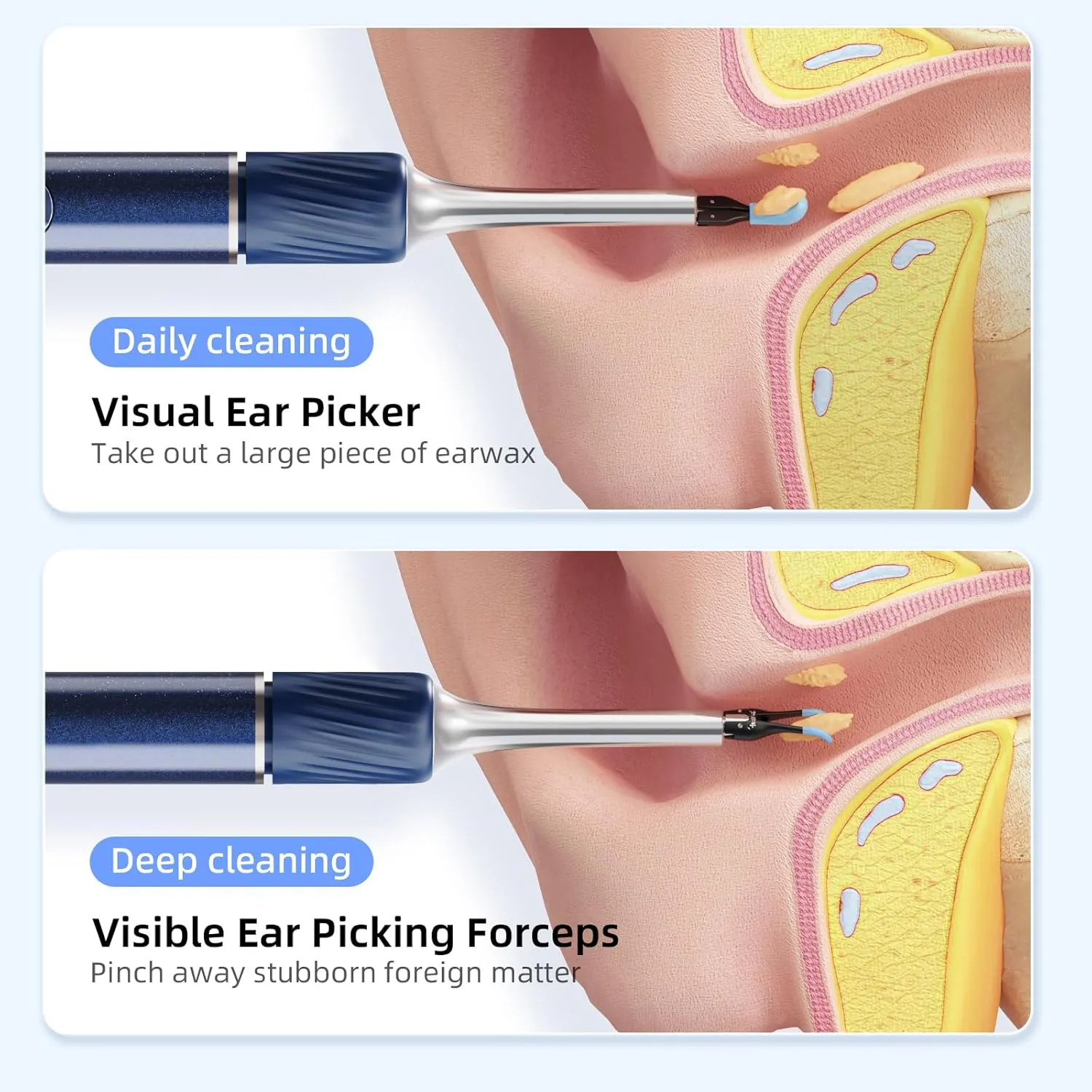 Qimic Ear Camera with Tweezers - Ear Cleaner with Camera,1080P HD Earwax Removal Tool with Light, IP67 Ear Cleaning Kit with 6 Ear Spoon, Ear Camera Otoscope for iPhone, Android